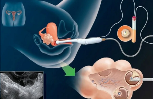 宜春借卵试管包生男孩套餐：试管婴儿胚胎移植后是否有必要进行强有力的营养补充？