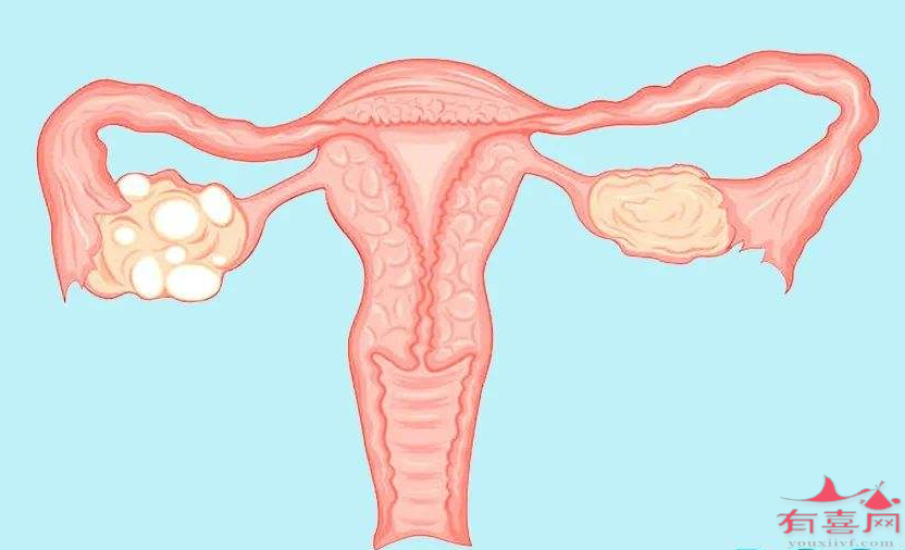 青岛合法供卵成功率-多囊卵巢一定要做试管婴儿吗？