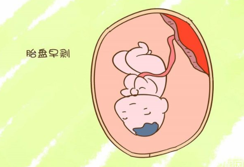 重庆借腹生子价格表-胎盘早剥的症状是什么，胎盘早剥有哪些痛苦的特征？